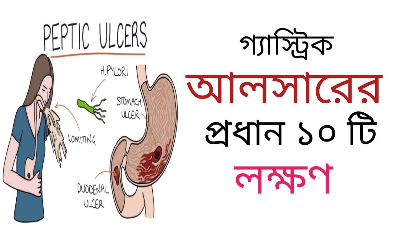 গ্যাস্ট্রিক আলসার এর লক্ষণ 1 গ্যাস্ট্রিক আলসার এর লক্ষণ